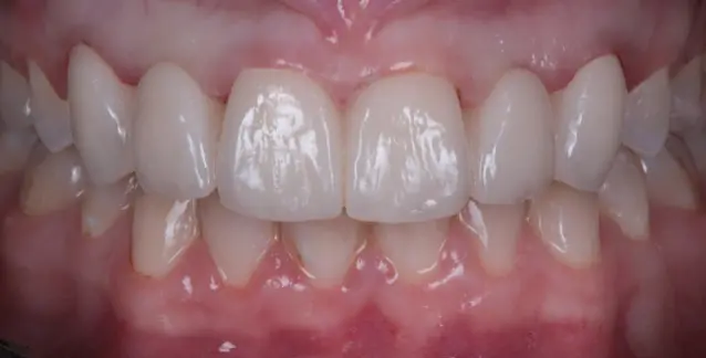 Красива усмішка з високоякісними імплантами – перетворіть свою усмішку сьогодні!