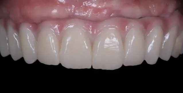 Красива усмішка з високоякісними імплантами – перетворіть свою усмішку сьогодні!