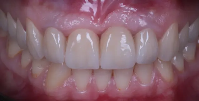 Красива усмішка з високоякісними імплантами – перетворіть свою усмішку сьогодні!