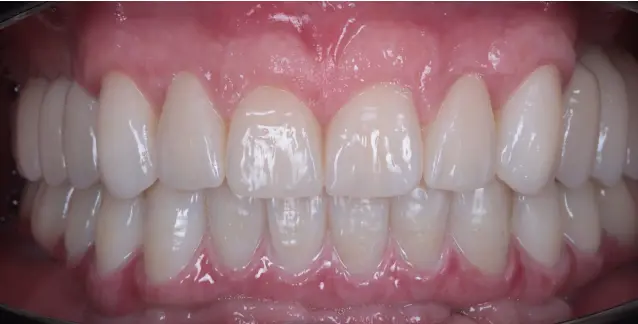 Красива усмішка з високоякісними імплантами – перетворіть свою усмішку сьогодні!