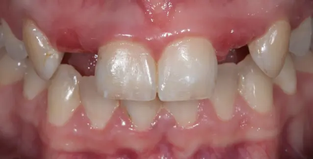 Красива усмішка з високоякісними імплантами – перетворіть свою усмішку сьогодні!