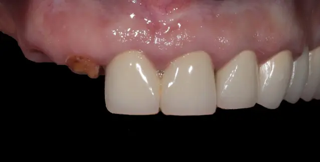 Красива усмішка з високоякісними імплантами – перетворіть свою усмішку сьогодні!