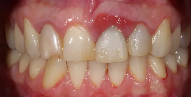 Красива усмішка з високоякісними імплантами – перетворіть свою усмішку сьогодні!