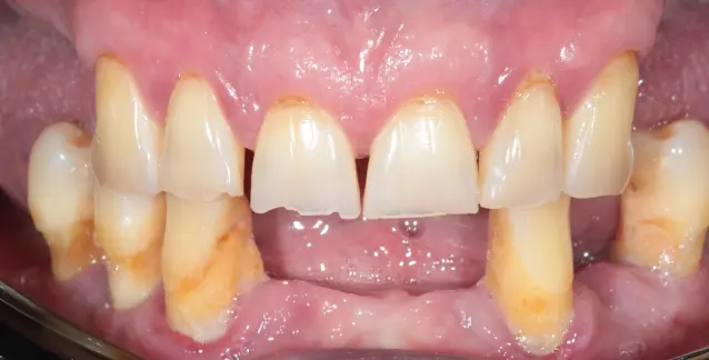 Красива усмішка з високоякісними імплантами – перетворіть свою усмішку сьогодні!