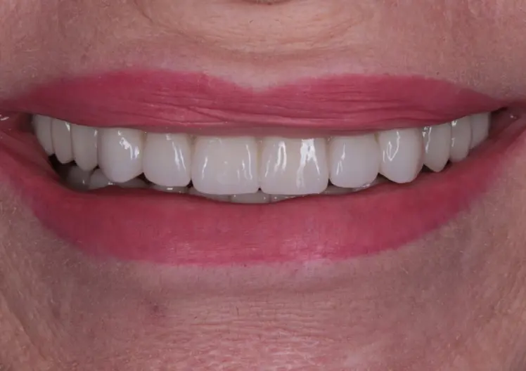 Результат встановлення керамічних вінірів в Ужгороді – ідеальна усмішка після стоматологічного лікування в Picasso Dental Clinic.