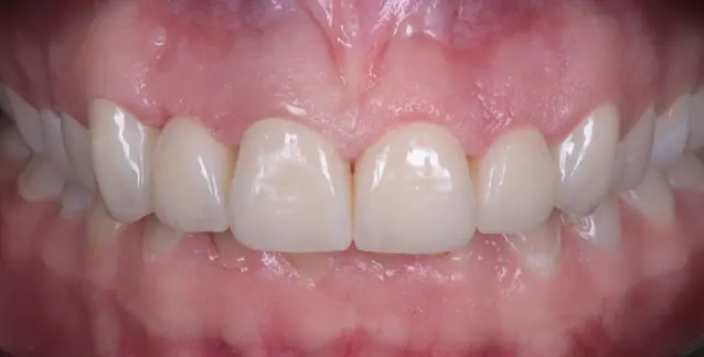 Красива усмішка з високоякісними вінірами – перетворіть свою усмішку сьогодні!