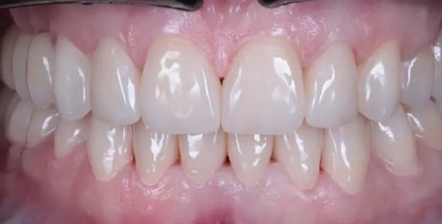 Красива усмішка з високоякісними вінірами – перетворіть свою усмішку сьогодні!