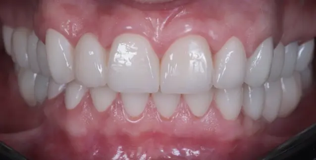 Красива усмішка з високоякісними вінірами – перетворіть свою усмішку сьогодні!