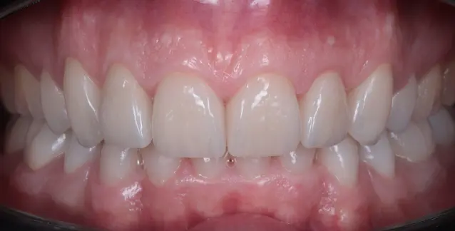 Красива усмішка з високоякісними вінірами – перетворіть свою усмішку сьогодні!