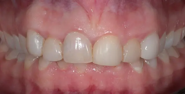 Красива усмішка з високоякісними вінірами – перетворіть свою усмішку сьогодні!