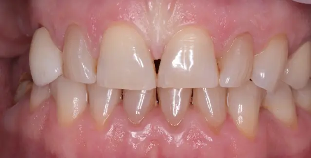 Красива усмішка з високоякісними вінірами – перетворіть свою усмішку сьогодні!