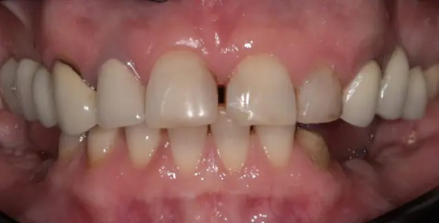 Красива усмішка з високоякісними вінірами – перетворіть свою усмішку сьогодні!