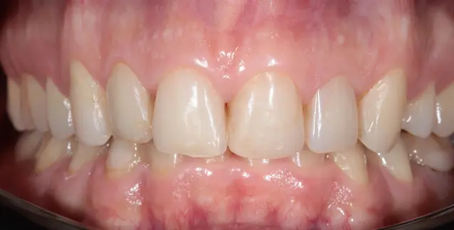 Красива усмішка з високоякісними вінірами – перетворіть свою усмішку сьогодні!