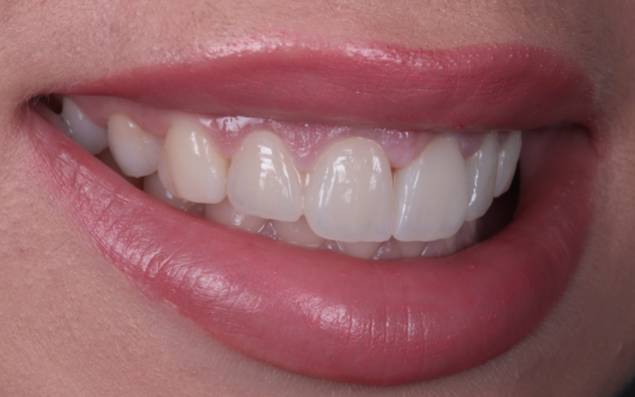 Вініри до і після – результат встановлення керамічних вінірів в Ужгороді. Естетична стоматологія Picasso Dental Clinic, реставрація зубів, вініри ціна Ужгород.