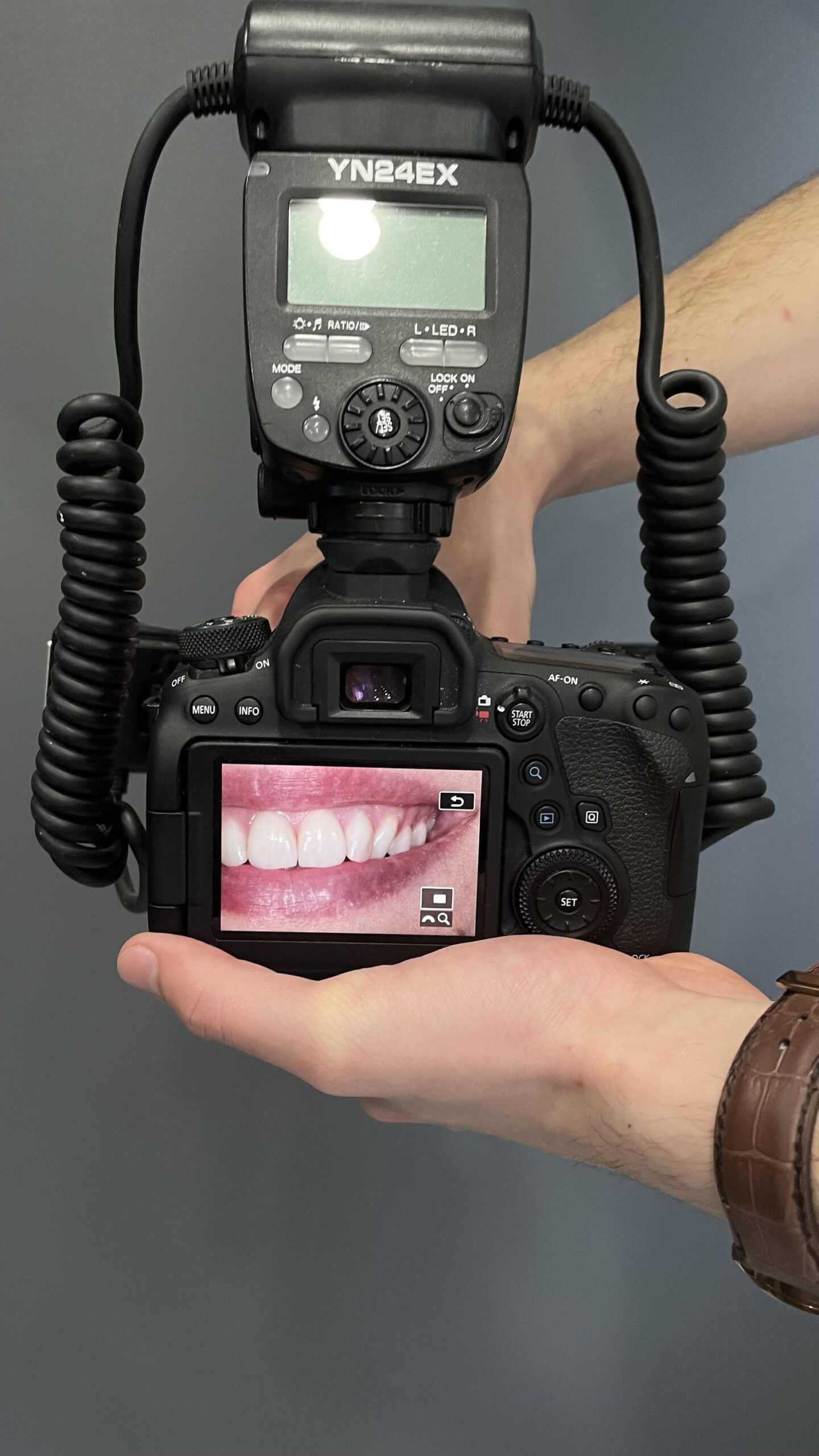 Що таке керамічна реставрація на імпланті?