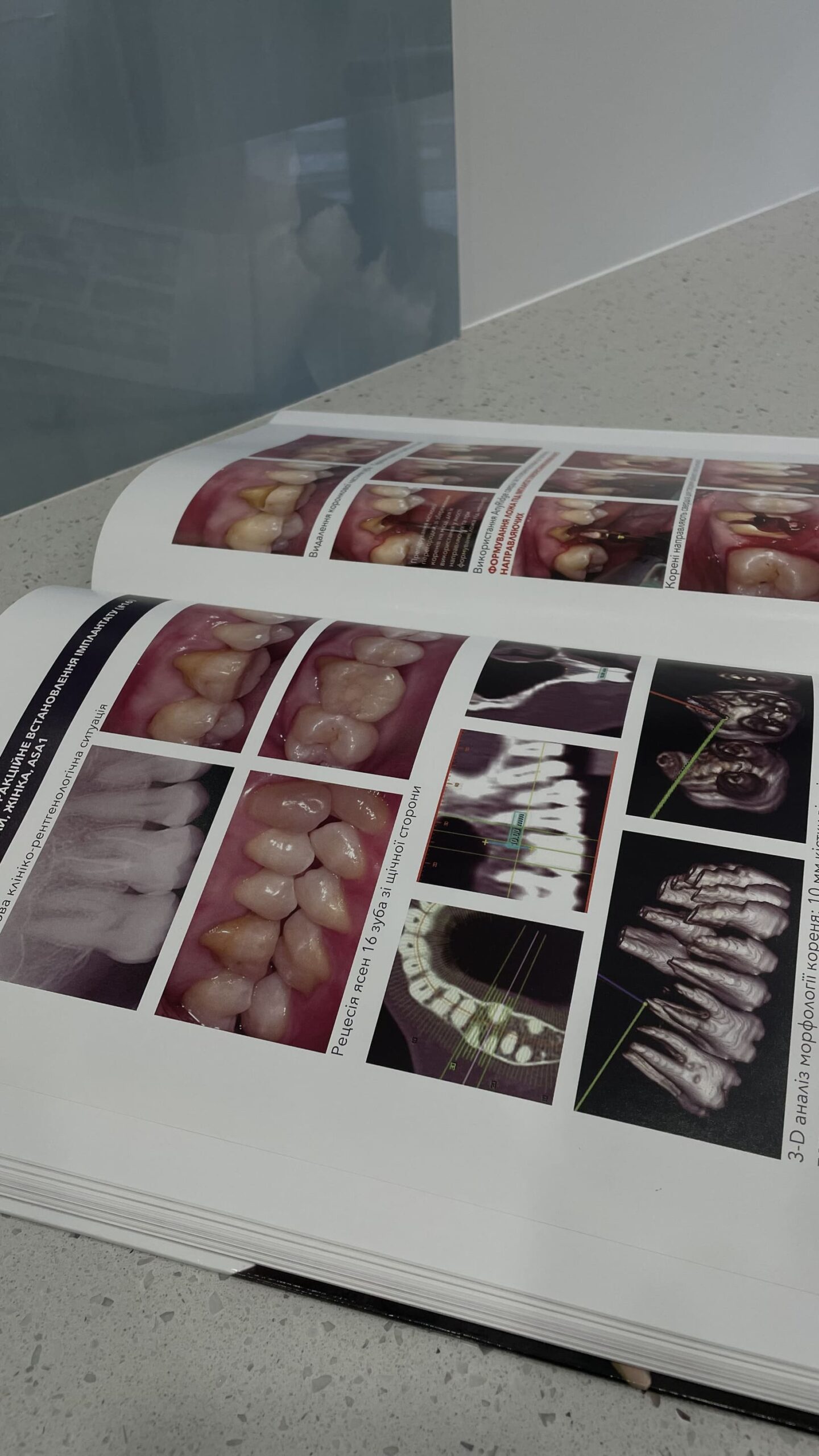 Про керамічні коронки