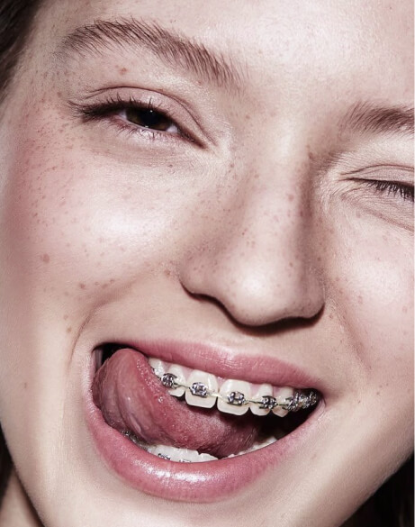 Як працюють брекети: продумана фізика, а не сила