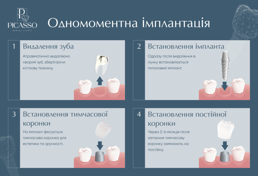 Що таке одномоментна імплантація - діаграма PICASSO Ужгород
