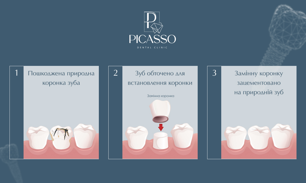 Як ставлять коронки на зуби: етапи встановлення коронки у стоматології PICASSO в Ужгороді