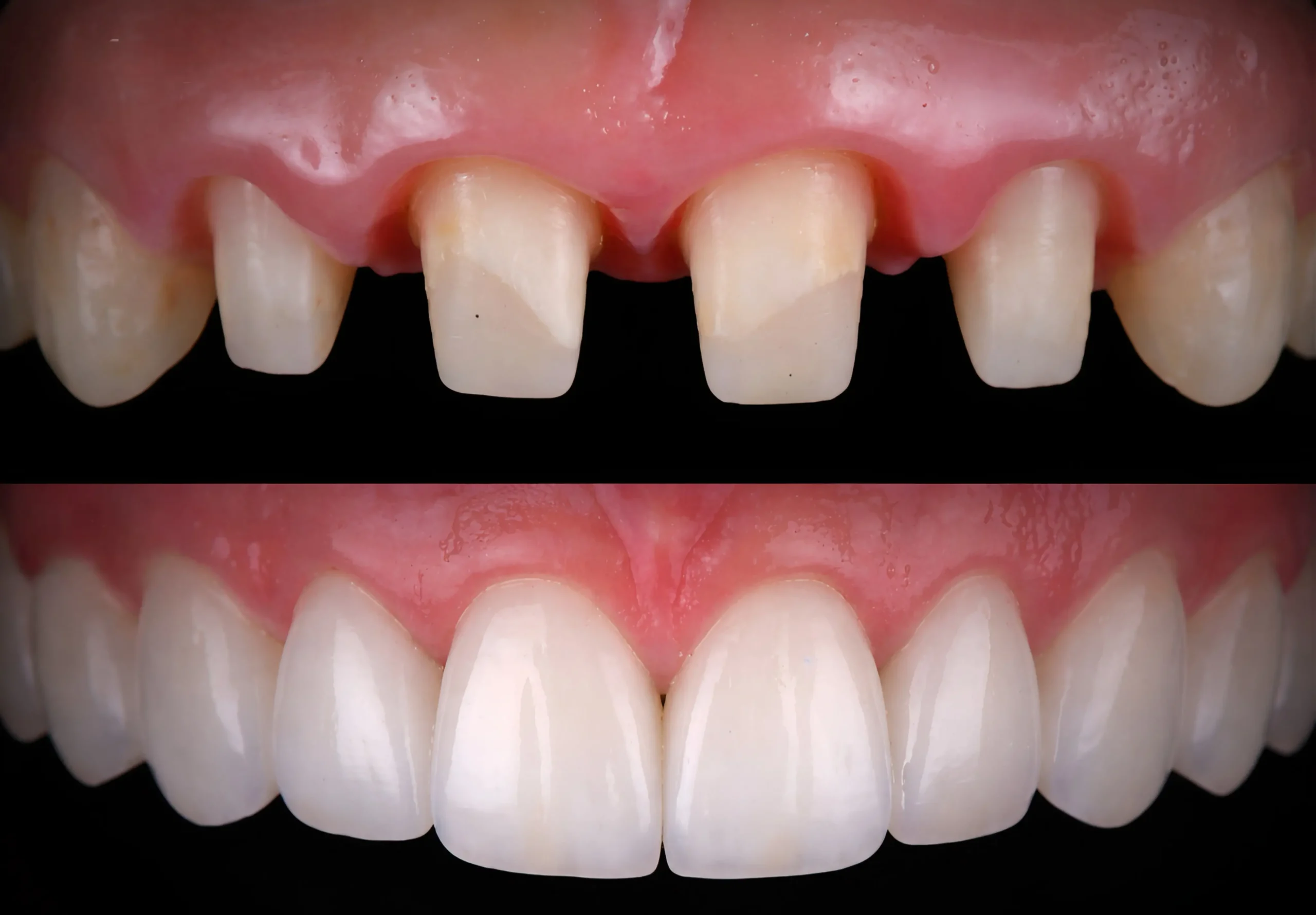 Як ставлять коронки на передні зуби