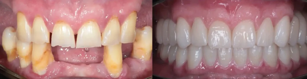 До і після протезування передніх зубів керамічними коронками у клініці PICASSO, Ужгород