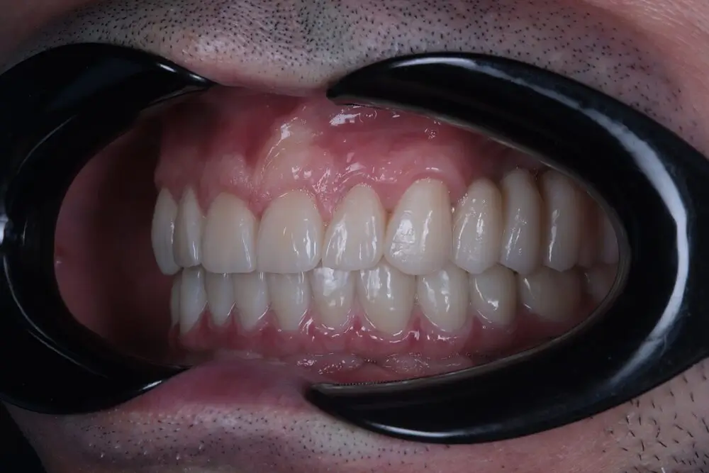 Посмішка після встановлення імплантів