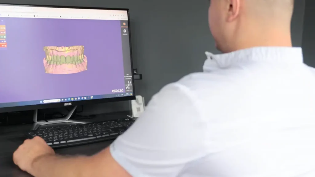 Цифровий 3D-скан щелепи у процесі — моделювання коронки на передні зуби на екрані комп’ютера (exocad)