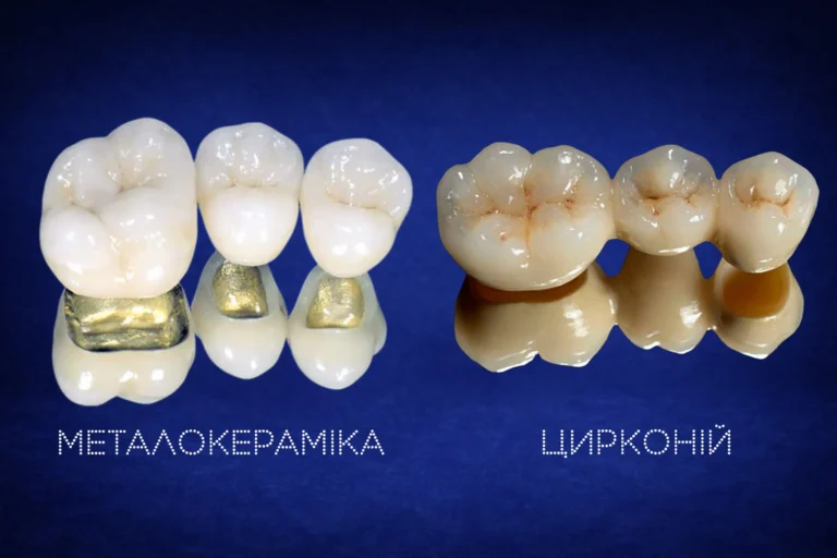 Що краще металокераміка чи цирконій?