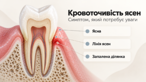 кровоточивість ясен