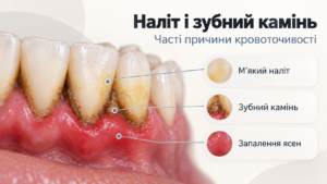 наліт та зубний камінь